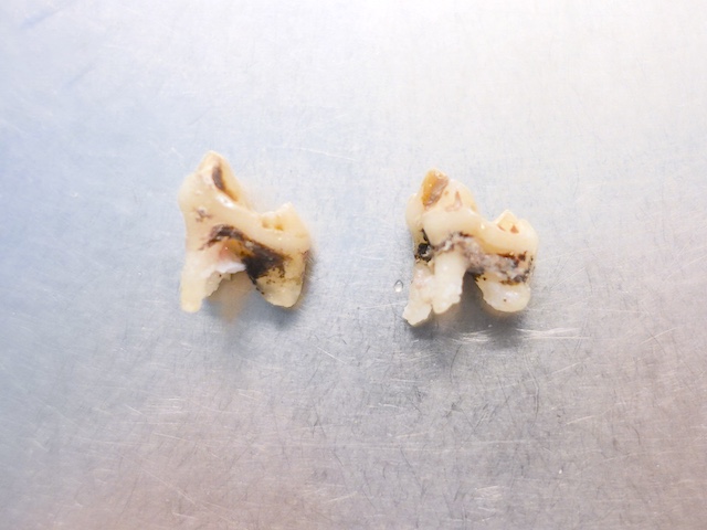 抜歯後の歯