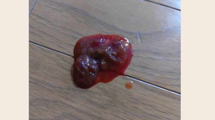 血の混じった便